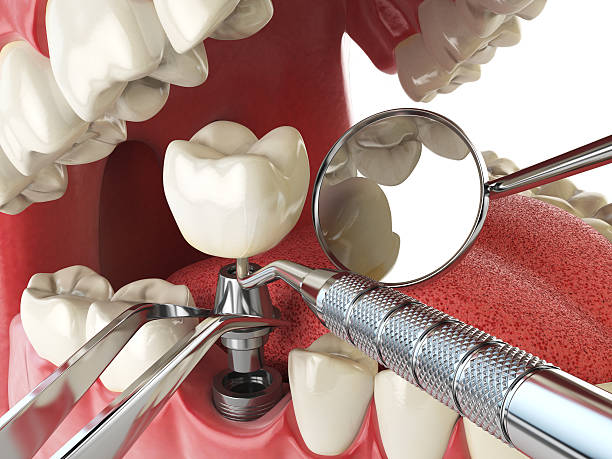 Best Lost Filling or Crown Replacement in Greenbriar, FL